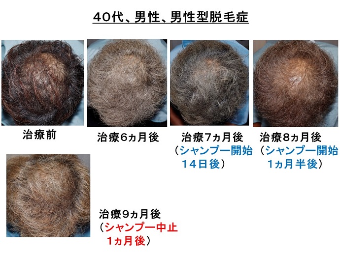 円形脱毛症　病院